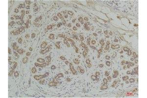Immunohistochemistry (IHC) analysis of paraffin-embedded Human Breast Carcinoma using EphA1 Rabbit Polyclonal Antibody diluted at 1:200. (EPHA1 Antikörper)