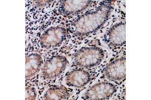 Immunohistochemical analysis of Collagen 17 alpha 1 staining in human colon cancer formalin fixed paraffin embedded tissue section. (COL17A1 Antikörper)