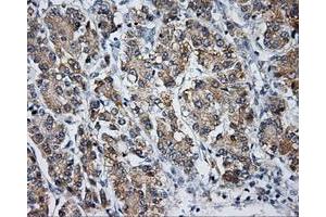 Immunohistochemical staining of paraffin-embedded Carcinoma of liver tissue using anti-LIPG mouse monoclonal antibody. (LIPG Antikörper)