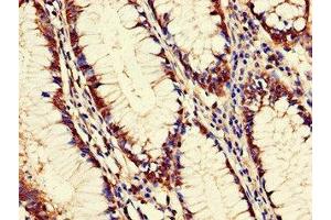 Immunohistochemistry of paraffin-embedded human colon cancer using ABIN7162603 at dilution of 1:100 (PANK2 Antikörper  (AA 437-490))