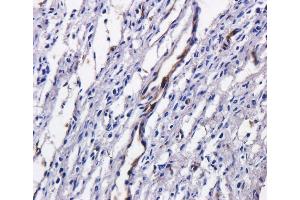Immunohistochemical staining of human ovarian cancer using anti-TAG72 antibody  Formalin fixed human ovarian cancer slices were were stained with  at 5 µg/ml.
