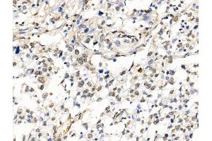 ABIN6262190 and ABIN6269019 at 1/100 staining Human pancreatic cancer by IHC-P. (HDAC7 Antikörper  (C-Term))