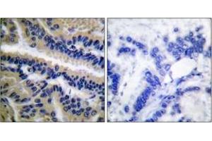 Immunohistochemistry analysis of paraffin-embedded human lung carcinoma tissue, using Caspase 9 (Cleaved-Asp353) Antibody. (Caspase 9 Antikörper  (Cleaved-Asp353))