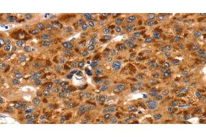 Immunohistochemistry of paraffin-embedded Human liver cancer using TLN1 Polyclonal Antibody at dilution of 1:35 (TLN1 Antikörper)