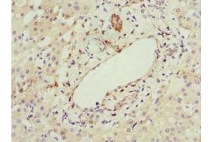 Immunohistochemistry of paraffin-embedded human liver cancer using ABIN7167073 at dilution of 1:100 (HBXIP Antikörper  (AA 1-91))