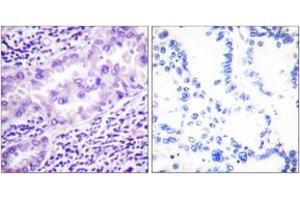 Immunohistochemistry analysis of paraffin-embedded human lung carcinoma, using PP2A-alpha (Phospho-Tyr307) Antibody. (PPP2CA Antikörper  (pTyr307))