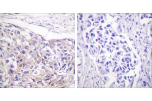 Immunohistochemistry analysis of paraffin-embedded human breast carcinoma tissue using p90 RSK (Phospho-Thr573) antibody. (RPS6KA3 Antikörper  (pThr573))