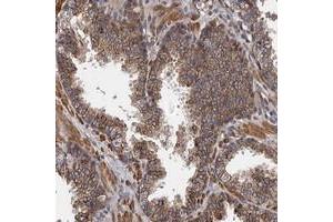 Immunohistochemical staining of human prostate with KIAA1609 polyclonal antibody  shows moderate cytoplasmic positivity in glandular cells at 1:500-1:1000 dilution. (KIAA1609 Antikörper)