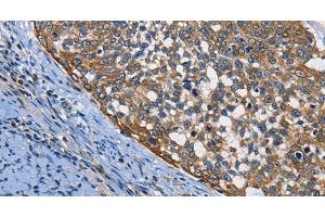 Immunohistochemistry of paraffin-embedded Human cervical cancer using PGK1 Polyclonal Antibody at dilution of 1:50 (PGK1 Antikörper)