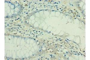Immunohistochemistry of paraffin-embedded human colon cancer using ABIN7156908 at dilution of 1:100