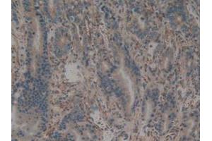 IHC-P analysis of Human Stomach Cancer Tissue, with DAB staining. (CALU Antikörper  (AA 20-315))