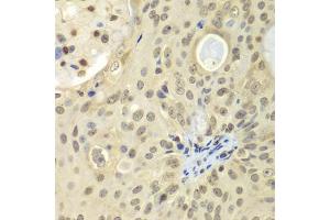 Immunohistochemistry of paraffin-embedded human oophoroma using ULK4 antibody (ABIN5975557) at dilution of 1/100 (40x lens). (ULK4 Antikörper)