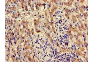 Immunohistochemistry of paraffin-embedded human liver cancer using ABIN7142142 at dilution of 1:100 (ACMSD Antikörper  (AA 33-129))