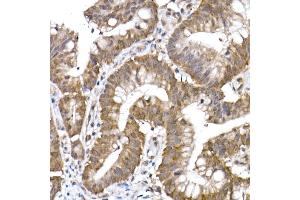 Immunohistochemistry of paraffin-embedded human colon carcinoma using PPCS Rabbit mAb (ABIN7269360) at dilution of 1:25 (40x lens). (PPCS Antikörper)