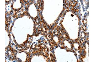 The image on the left is immunohistochemistry of paraffin-embedded Human thyroid cancer tissue using ABIN7191529(MTNR1A Antibody) at dilution 1/40, on the right is treated with synthetic peptide. (Melatonin Receptor 1A Antikörper)