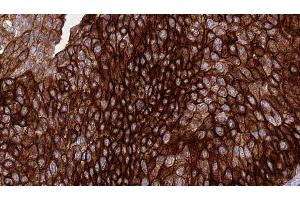 ABIN6276414 at 1/100 staining Human urothelial cancer tissue by IHC-P. (ERBB3 Antikörper  (C-Term))