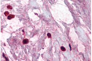 Human Breast, Mast Cells (formalin-fixed, paraffin-embedded) stained with TPSAB1 antibody ABIN337075 at 2. (TPSAB1 Antikörper)