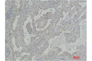 Immunohistochemistry (IHC) analysis of paraffin-embedded Human Lung Carcinoma using Akt2 Polyclonal Antibody. (AKT2 Antikörper)