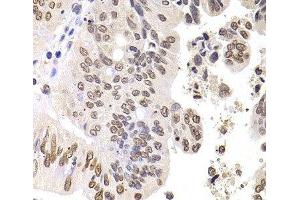 Immunohistochemistry of paraffin-embedded Human colon carcinoma using SOX5 Polyclonal Antibody at dilution of 1:100 (40x lens). (SOX5 Antikörper)