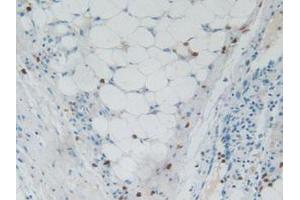 IHC-P analysis of Human Skin Cancer Tissue, with DAB staining. (RNASE3 Antikörper  (AA 30-154))
