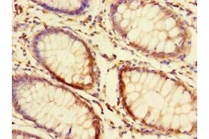 Immunohistochemistry of paraffin-embedded human colon cancer using ABIN7165390 at dilution of 1:100 (FAM131A Antikörper  (AA 1-281))