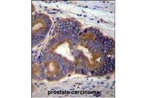 Y Antibody (C-term) (ABIN655601 and ABIN2845085) immunohistochemistry analysis in formalin fixed and paraffin embedded human prostate carcinoma followed by peroxidase conjugation of the secondary antibody and DAB staining. (YI016 (AA 253-280), (C-Term) Antikörper)