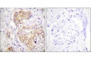 Immunohistochemistry analysis of paraffin-embedded human breast carcinoma tissue, using PKC delta (Ab-505) Antibody. (PKC delta Antikörper  (AA 471-520))