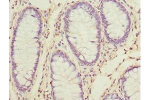 Immunohistochemistry of paraffin-embedded human colon cancer using ABIN7170671 at dilution of 1:100 (SKAP2 Antikörper  (AA 1-120))