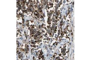 Immunohistochemistry analysis of paraffin-embedded human cervical cancer using BACH1 antibody at dilution of 1/100. (BACH1 Antikörper)