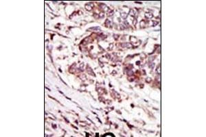 Formalin-fixed and paraffin-embedded human cancer tissue reacted with the primary antibody, which was peroxidase-conjugated to the secondary antibody, followed by AEC staining. (CAMK1G Antikörper  (C-Term))