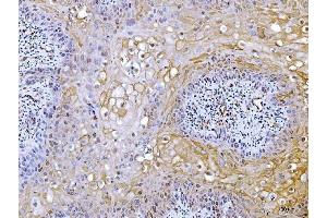 IHC analysis of ACLY using anti-ACLY antibody (ABIN4886416). (ACLY Antikörper  (AA 1-180))