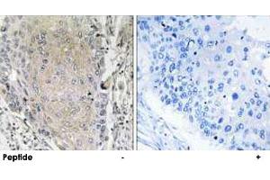 Immunohistochemistry analysis of paraffin-embedded human lung carcinoma tissue using CBLN3 polyclonal antibody . (CBLN3 Antikörper)