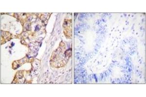 Immunohistochemistry analysis of paraffin-embedded human colon carcinoma tissue, using Keratin 8 (Ab-431) Antibody. (KRT8 Antikörper  (AA 401-450))