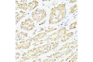 Immunohistochemistry of paraffin-embedded human colon carcinoma using CREB1 antibody (ABIN6290133) at dilution of 1:100 (40x lens). (CREB1 Antikörper)