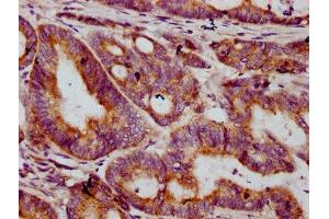 IHC image of ABIN7149158 diluted at 1:400 and staining in paraffin-embedded human colon cancer performed on a Leica BondTM system. (COX2 Antikörper  (AA 83-227))