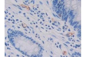 Detection of GC in Human Stomach cancer Tissue using Polyclonal Antibody to Glycocalicin (GC) (Glycocalicin Antikörper  (AA 136-276))