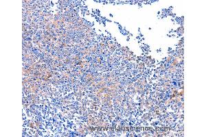 Immunohistochemistry of Human ovarian cancer using PTK2 Polyclonal Antibody at dilution of 1:75 (FAK Antikörper)
