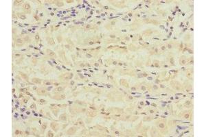Immunohistochemistry of paraffin-embedded human gastric cancer using ABIN7168157 at dilution of 1:100