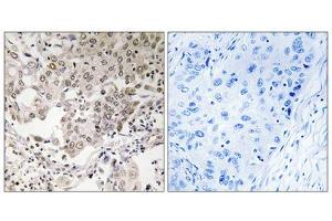 Immunohistochemistry analysis of paraffin-embedded human lung carcinoma tissue using NCAPG2 antibody. (NCAPG2 Antikörper  (Internal Region))