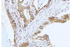 ABIN6275352 at 1/100 staining Human lung cancer tissue by IHC-P. (PEX2 Antikörper  (Internal Region))