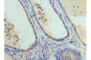 Immunohistochemistry of paraffin-embedded human prostate cancer using ABIN7152009 at dilution of 1:100 (GATA1 Antikörper  (AA 39-153))
