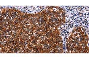 Immunohistochemistry of paraffin-embedded Human cervical cancer tissue using USP2 Polyclonal Antibody at dilution 1:40 (USP2 Antikörper)