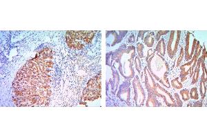 Immunohistochemical analysis of paraffin-embedded liver cancer (right) and colon cancer tissues (left) using KLHL11 mouse mAb with DAB staining. (KLHL11 Antikörper)