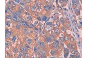IHC-P analysis of Human Breast cancer Tissue, with DAB staining. (Complement Factor B Antikörper  (AA 35-160))