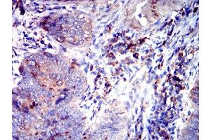 Immunohistochemical analysis of paraffin-embedded rectum cancer tissues using CD53 mouse mAb with DAB staining. (CD53 Antikörper)