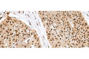 Immunohistochemistry of paraffin-embedded Human esophagus cancer tissue using FBXO32 Polyclonal Antibody at dilution of 1:60(x200) (FBXO32 Antikörper)
