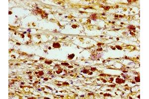 Immunohistochemistry of paraffin-embedded human melanoma using ABIN7161402 at dilution of 1:100 (Septin 3 Antikörper  (AA 238-358))