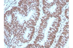 Formalin-fixed, paraffin-embedded human Colon Carcinoma stained with PAX2 Mouse Monoclonal Antibody (PAX2/1104). (PAX2A Antikörper  (AA 223-354))