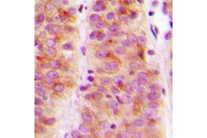 Immunohistochemical analysis of SLK staining in human breast cancer formalin fixed paraffin embedded tissue section. (SLK Antikörper  (C-Term))