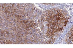 ABIN6276957 at 1/100 staining Human urothelial cancer tissue by IHC-P. (Macrophage Scavenger Receptor 1 Antikörper  (N-Term))